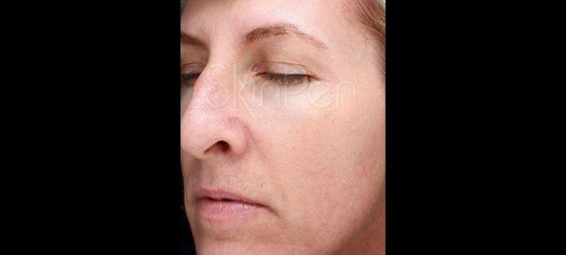 Microneedling after at Vitalyc Medspa | Highland Park in Dallas, TX