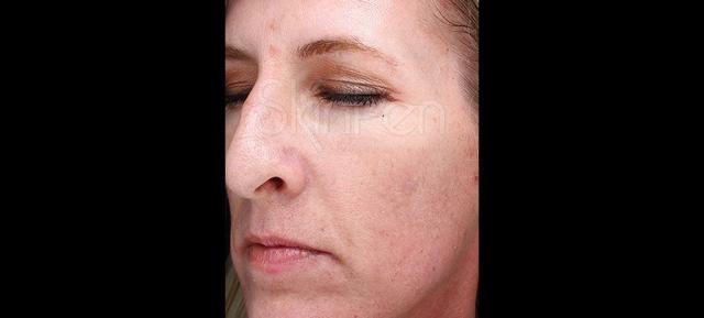 Microneedling before at Vitalyc Medspa | Highland Park in Dallas, TX