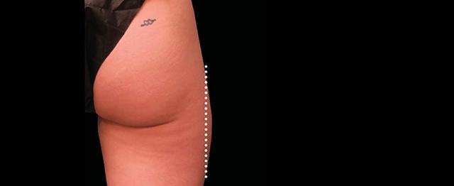 Thigh Lift after at Vitalyc Medspa | Highland Park in Dallas, TX