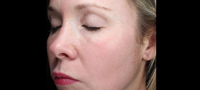 Laser Skin Resurfacing after at Vitalyc Medspa | Highland Park in Dallas, TX