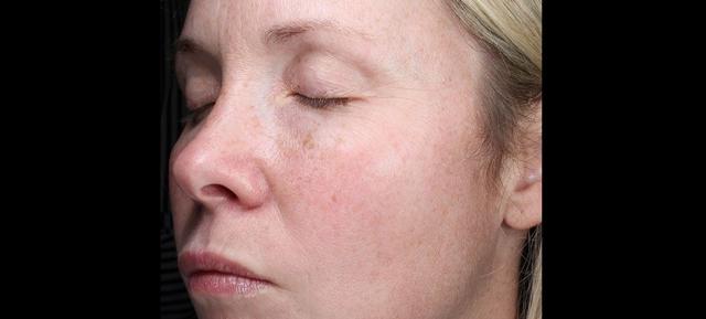 Laser Skin Resurfacing before at Vitalyc Medspa | Highland Park in Dallas, TX