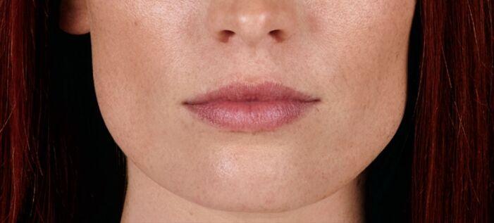 Vitalyc Medspa | Highland Park lip filler after — Dallas, TX