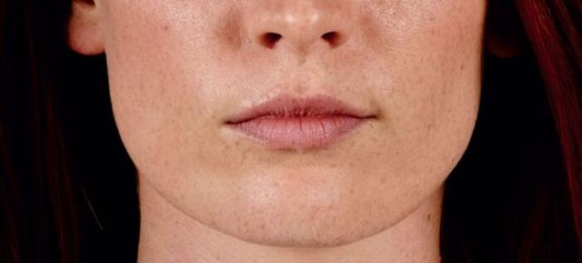 Lip Filler before at Vitalyc Medspa | Highland Park in Dallas, TX