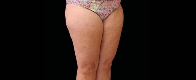 Thigh Lift after at Vitalyc Medspa | Highland Park in Dallas, TX