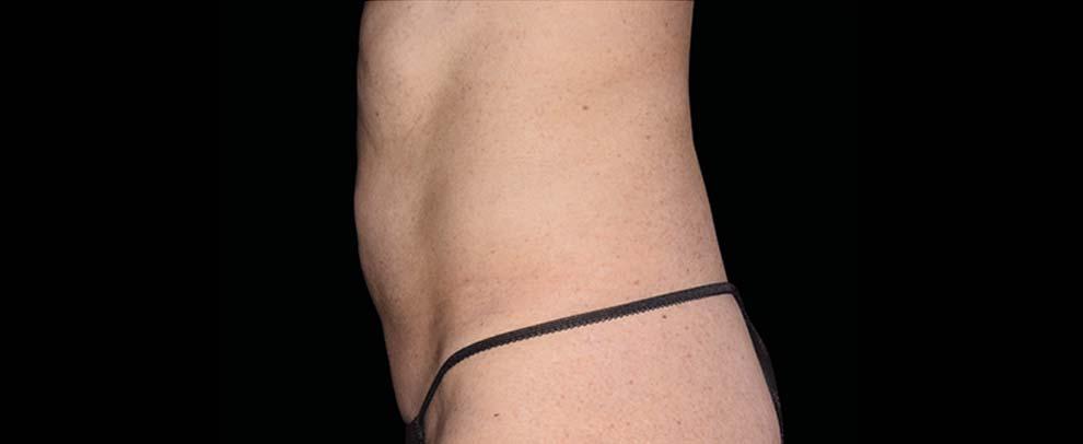 Vitalyc Medspa | Highland Park body contouring after — Dallas, TX