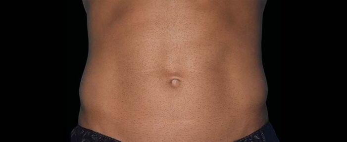 Vitalyc Medspa | Highland Park body contouring after — Dallas, TX