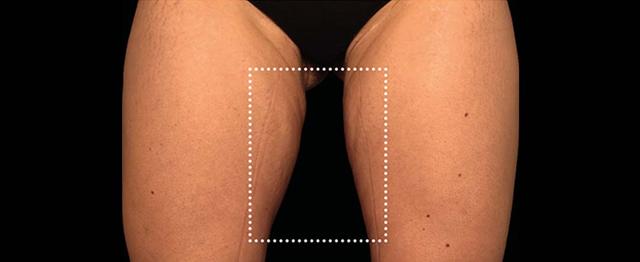 Thigh Lift after at Vitalyc Medspa | Highland Park in Dallas, TX