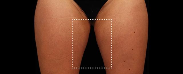 Thigh Lift before at Vitalyc Medspa | Highland Park in Dallas, TX