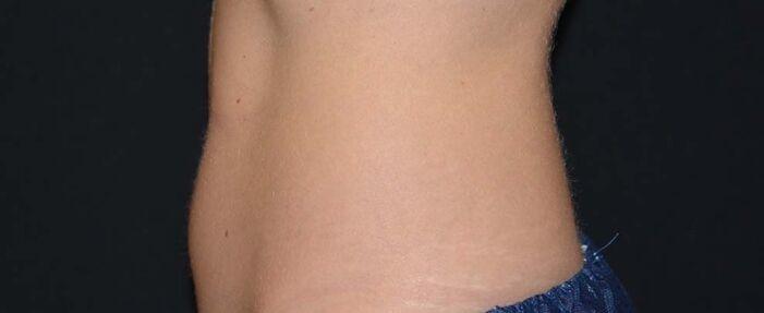 Vitalyc Medspa | Highland Park coolsculpting after — Dallas, TX