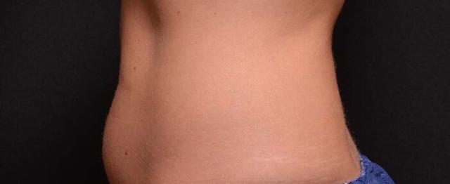 CoolSculpting before at Vitalyc Medspa | Highland Park in Dallas, TX