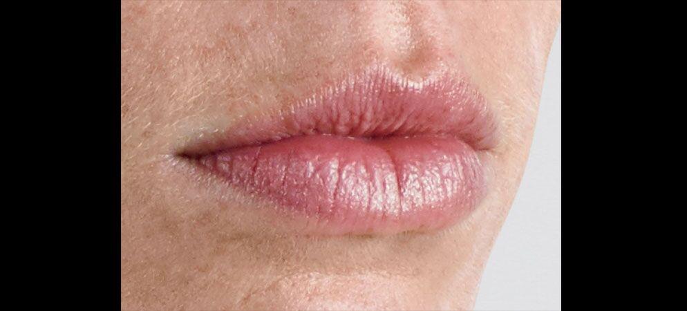 Vitalyc Medspa | Highland Park lip filler after — Dallas, TX
