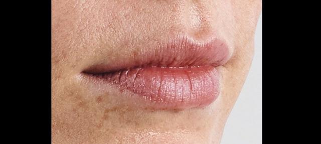 Lip Filler before at Vitalyc Medspa | Highland Park in Dallas, TX