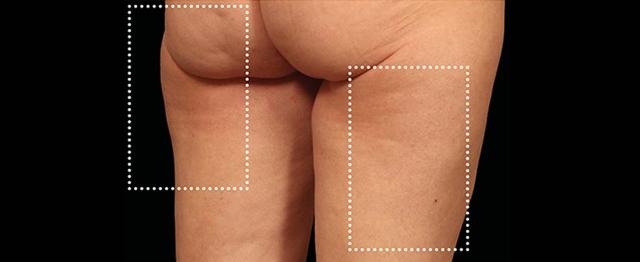 Thigh Lift after at Vitalyc Medspa | Highland Park in Dallas, TX