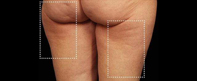 Thigh Lift before at Vitalyc Medspa | Highland Park in Dallas, TX