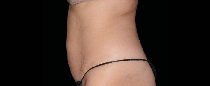 Vitalyc Medspa | Highland Park body contouring after — Dallas, TX