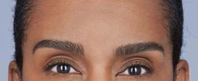 Botox after at Vitalyc Medspa | Highland Park in Dallas, TX