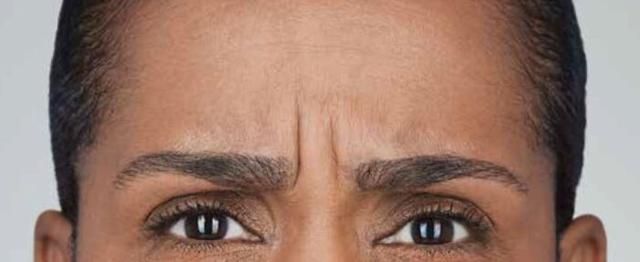 Botox before at Vitalyc Medspa | Highland Park in Dallas, TX