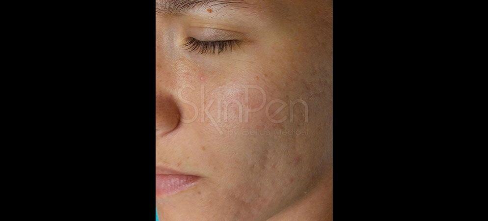 Vitalyc Medspa | Highland Park microneedling after — Dallas, TX