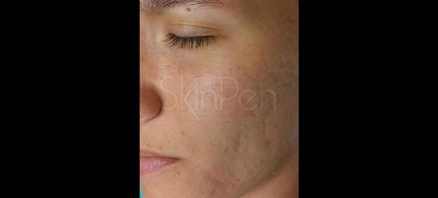 Microneedling after at Vitalyc Medspa | Highland Park in Dallas, TX
