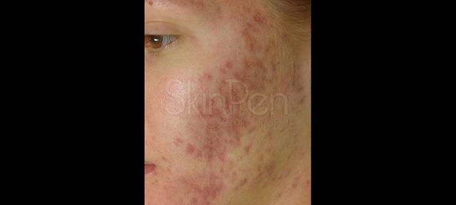 Microneedling before at Vitalyc Medspa | Highland Park in Dallas, TX