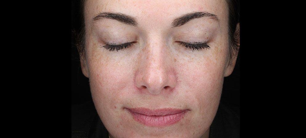 Vitalyc Medspa | Highland Park bbl after — Dallas, TX