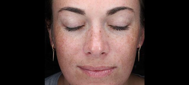 Chemical Peel before at Vitalyc Medspa | Highland Park in Dallas, TX