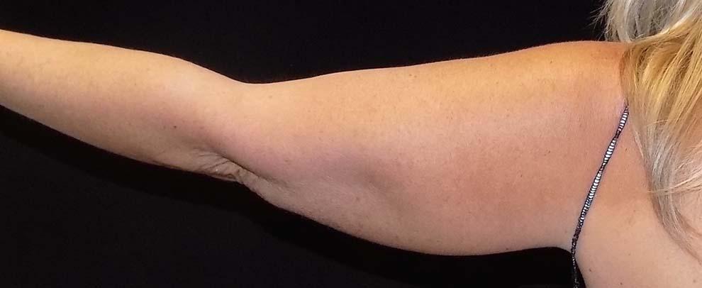Vitalyc Medspa | Highland Park coolsculpting after — Dallas, TX