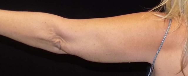 CoolSculpting before at Vitalyc Medspa | Highland Park in Dallas, TX
