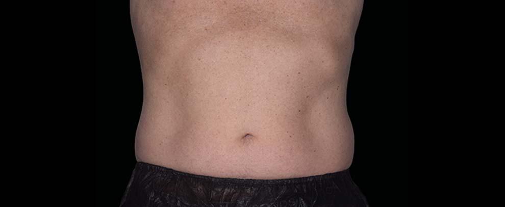 Vitalyc Medspa | Highland Park body contouring after — Dallas, TX