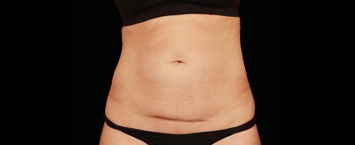 Vitalyc Medspa | Highland Park body contouring after — Dallas, TX