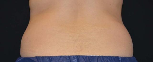 CoolSculpting before at Vitalyc Medspa | Highland Park in Dallas, TX