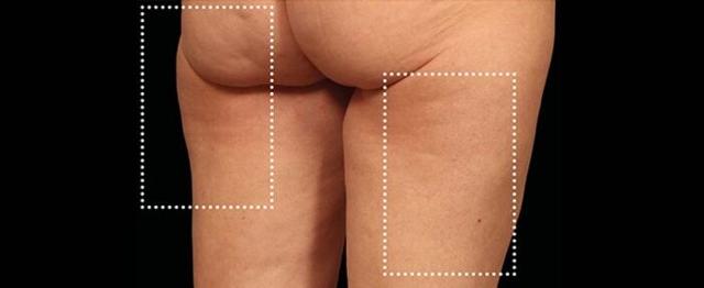 Thigh Lift after at Vitalyc Medspa | Highland Park in Dallas, TX