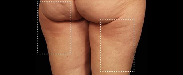 Thigh Lift before at Vitalyc Medspa | Highland Park in Dallas, TX