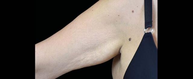 Arm Lift after at Vitalyc Medspa | Highland Park in Dallas, TX