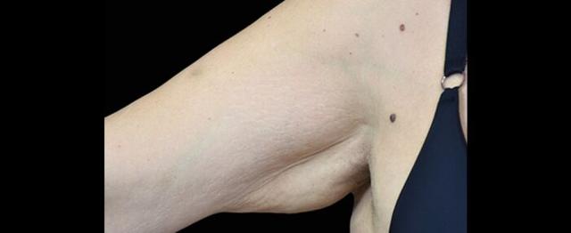 Arm Lift before at Vitalyc Medspa | Highland Park in Dallas, TX