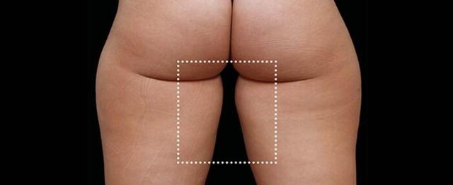 Thigh Lift after at Vitalyc Medspa | Highland Park in Dallas, TX