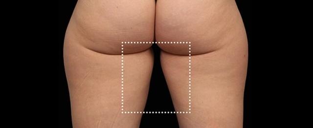 Thigh Lift before at Vitalyc Medspa | Highland Park in Dallas, TX