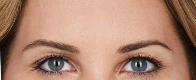 Botox after at Vitalyc Medspa | Highland Park in Dallas, TX