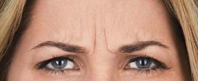Botox before at Vitalyc Medspa | Highland Park in Dallas, TX