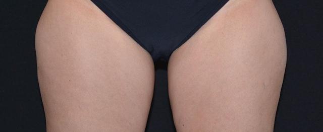 Thigh Lift before at Vitalyc Medspa | Highland Park in Dallas, TX