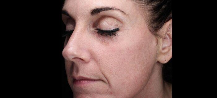 Vitalyc Medspa | Highland Park bbl after — Dallas, TX