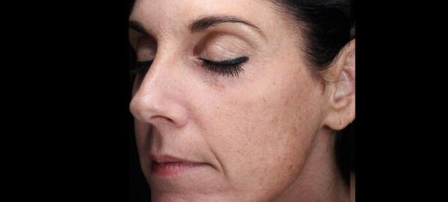 Laser Skin Resurfacing before at Vitalyc Medspa | Highland Park in Dallas, TX