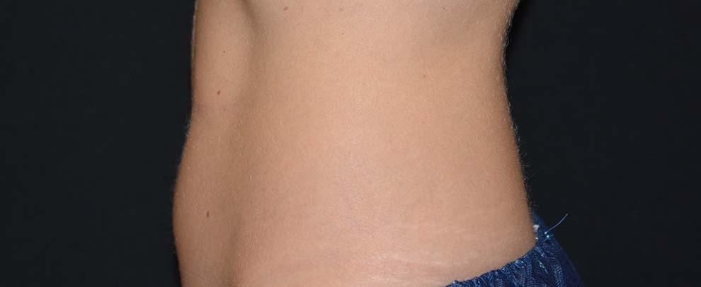 Vitalyc Medspa | Highland Park coolsculpting after — Dallas, TX
