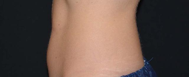 CoolSculpting after at Vitalyc Medspa | Highland Park in Dallas, TX