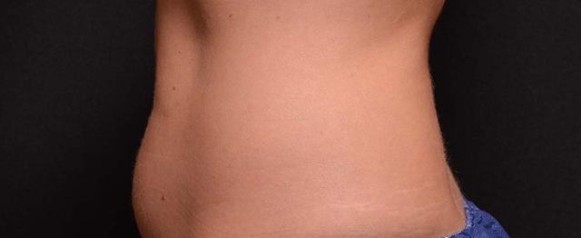 CoolSculpting before at Vitalyc Medspa | Highland Park in Dallas, TX