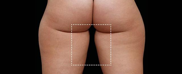 Thigh Lift after at Vitalyc Medspa | Highland Park in Dallas, TX