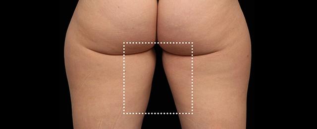 Thigh Lift before at Vitalyc Medspa | Highland Park in Dallas, TX