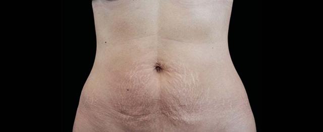 Chemical Peel after at Vitalyc Medspa | Highland Park in Dallas, TX