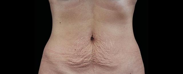 Chemical Peel before at Vitalyc Medspa | Highland Park in Dallas, TX