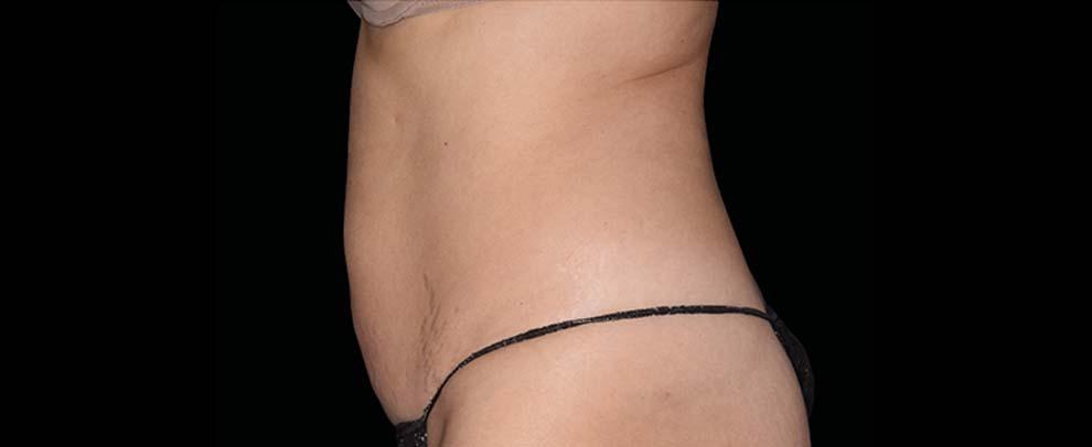 Vitalyc Medspa | Highland Park body contouring after — Dallas, TX